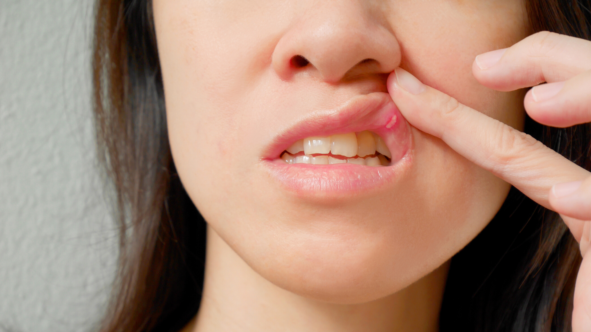 10-easy-tips-for-canker-sore-treatment-hubpages